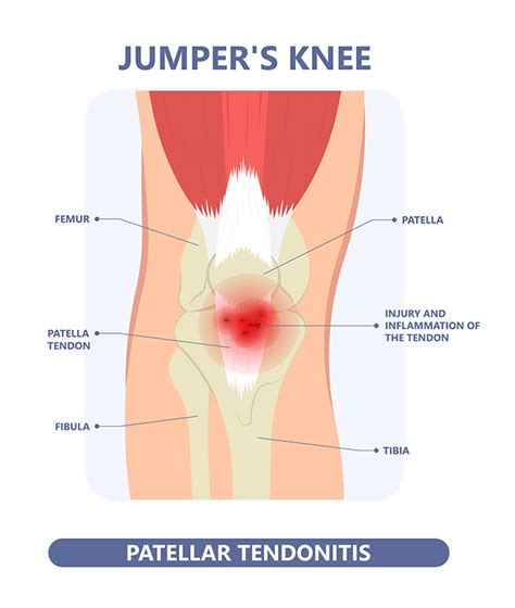 Patellar Tendinitis - Dr. Mohamed Attia, M.D. PhD