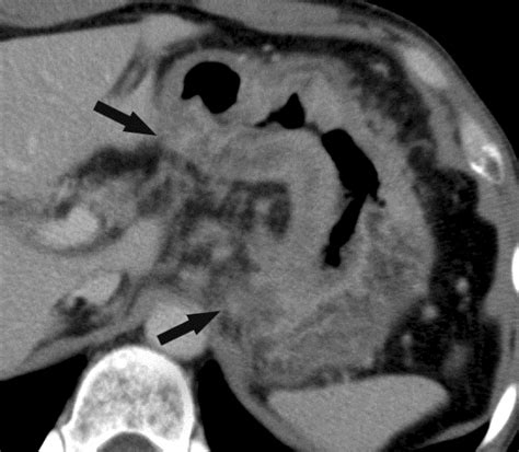 Stomach Cancer On Ct Scan