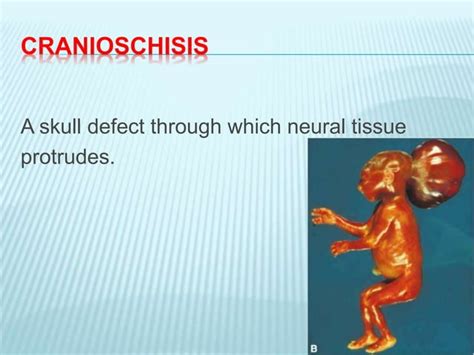 Neural tube defects | PPT