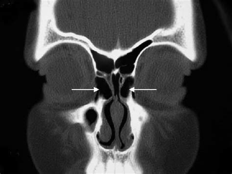 Anatomy Of The Frontal Recess And Frontal Sinus With Three Dimensional