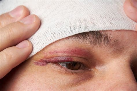 200 Eye Hematoma Stock Photos Pictures And Royalty Free Images Istock