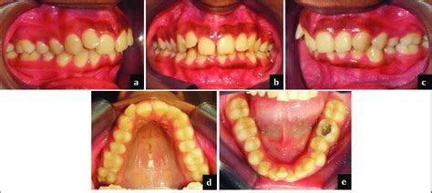 Pretreatment Intraoral Photographs A Right Buccal View B Anterior