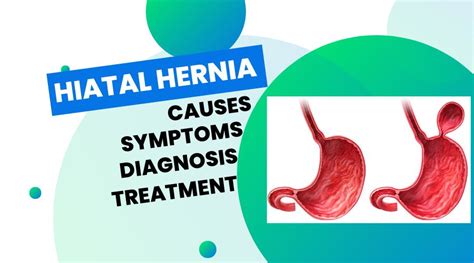 Hiatal Hernia (Causes, Symptoms, Diagnosis, Treatment) - Chiropractor