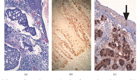 Figure 1 From Scrotal Apocrine Adenocarcinoma With Pagetoid Phenomenon