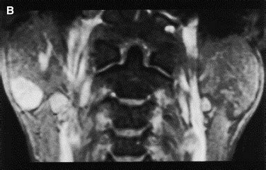 MR Imaging Findings Of Parotid Tumors With Pathologic Diagnostic Clues