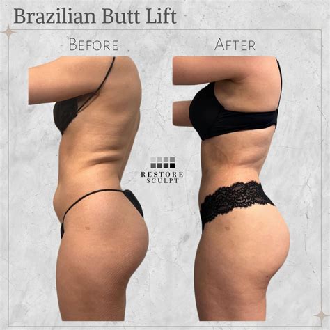 BRAZILIAN BUTT LIFT | BBL SURGERY - Restore Med Clinic