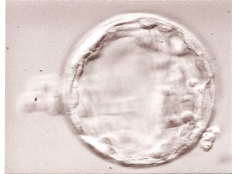 Pink And Blue Surrogacy Day 3 Vs Day 5 Embryo Transfer