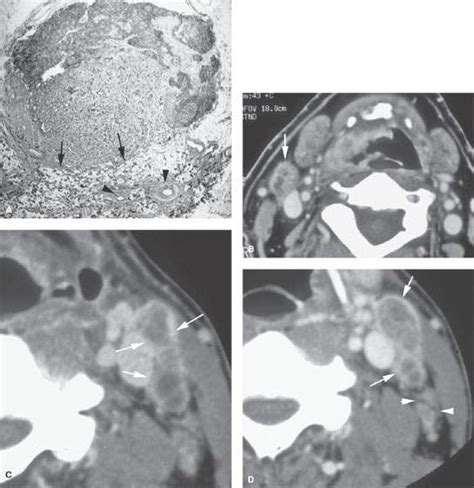 Cervical Metastatic Disease And The “unknown” Primary Radiology Key