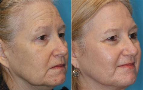 Halo Laser Skin Resurfacing Before And After Photo Gallery Toronto