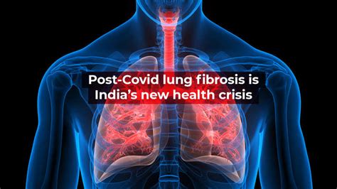 Post Covid Lung Fibrosis Is Indias New Health Crisis India News