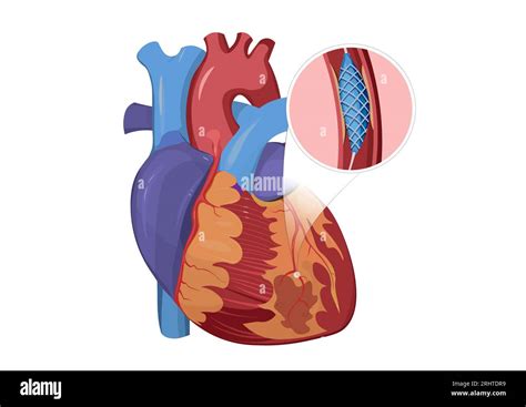 Human heart with stent, illustration Stock Photo - Alamy