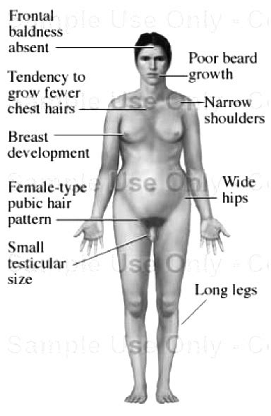 Symptoms of klinefelter syndrome | Download Scientific Diagram