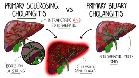 Primary Sclerosing Cholangitis V Primary Biliary Cholangitis Primary Biliary Cirrhosis Youtube