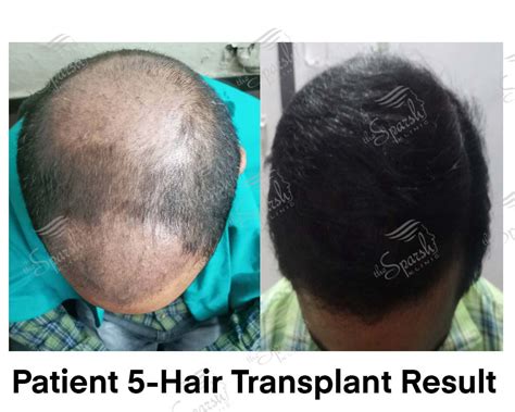 The Sparsh Clinic Best Hair Transplant In Lucknow Best Laser Treatment In Lucknow Skin