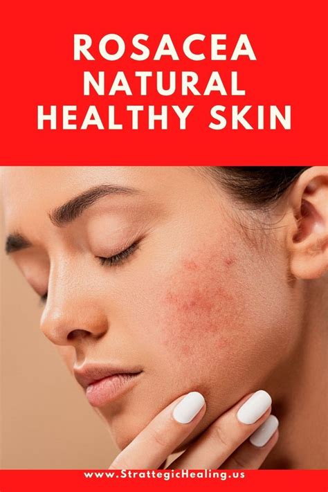 Rosacea Natural Skincare Healingmatters 77 In 2021 Rosacea