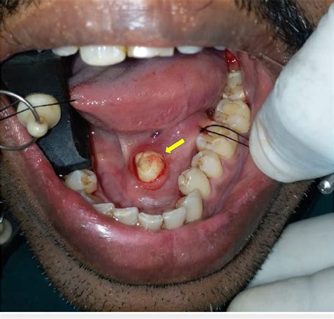 PDF Sialolithiasis Of The Submandibular Gland Report Of Cases