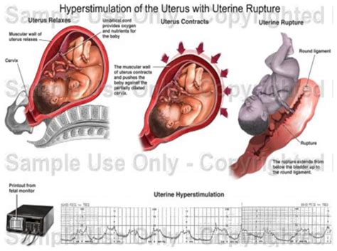 Intrapartum Emergencies Flashcards Quizlet