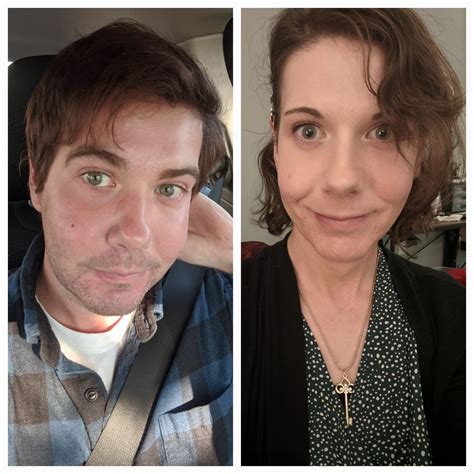 35 Mtf 20 Months Hrt Just A Bit Shy Of A Month Post Op Srs So Happy R Transtimelines