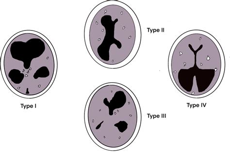 Patterns Of Hydrocephalus In Congenital Toxoplasmosis As Described By Download Scientific