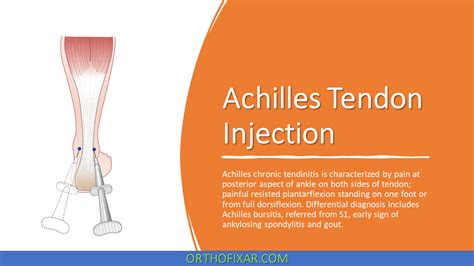 Achilles Tendon Injection Orthofixar 2025