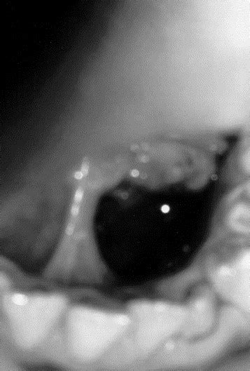 Treatment Of A Ranula Using An Ercrysgg Laser Journal Of Oral And