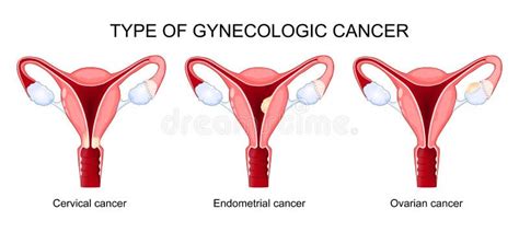 Type Gynaecologische Kanker Endometriumovarium En