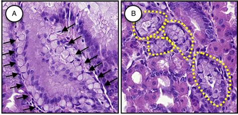 Hereditary Diffuse Gastric Cancer Updated Clinical Guidelines With An