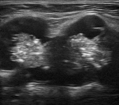 Cystic Neck Lymph Nodes Ultrasound