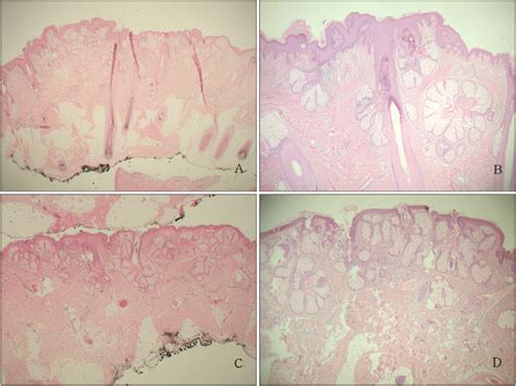 Sebaceous Gland Hyperplasia Lips Lipstutorial Org