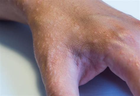 Arm And Hand Rash At Cheryl Talley Blog