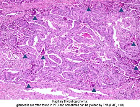 Pathology Outlines Papillary Thyroid Carcinoma Overview