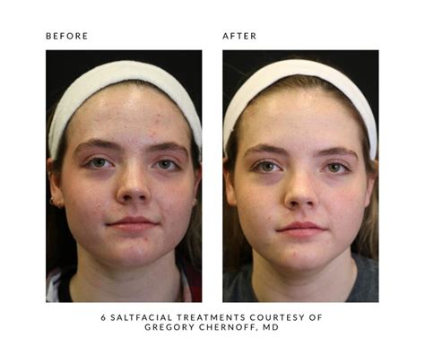 The Saltfacial® Skin Renewal Therapy Treatment By Saltmed