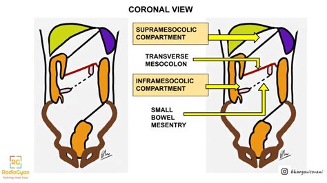 The Potential Spaces-Mapping the Peritoneal Cavity | RadioGyan .com