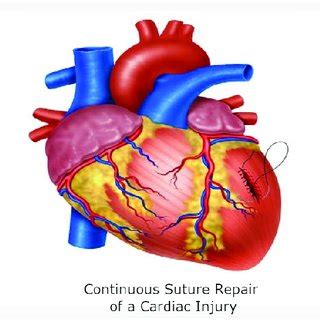 Surgical Management Algorithm For Penetrating Precordial Injuries