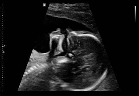 Cleft Lip 3d Ultrasound