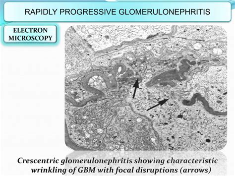 Glomerular Diseases Ppt