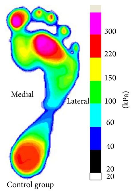 Plantar Pressure Distribution Between The Fifth Toe Deformed Group A