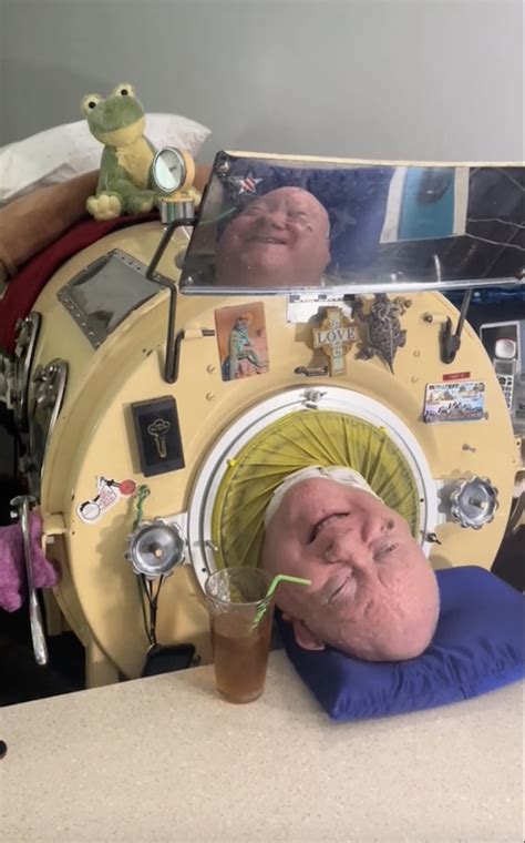 Longest Surviving Iron Lung Patient Paul Alexander Dies Leaves Inspiring Legacy