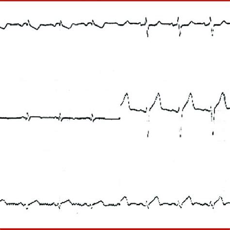 Tall T wave V1. Broad upright T wave V1>V6 with subtle septal (V1-V2 ...