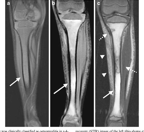 Osteomyelitis In Sickle Cell Disease Captions Energy