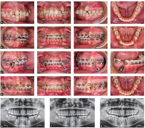 Scielo Brasil High Intensity Laser Application In Orthodontics High