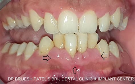 Painless Laser Gum Surgery Ahmedabad No Cut No Bleed No Stitch