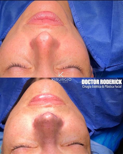 Rinoplastia Barcelona Kirurgio Medical Center