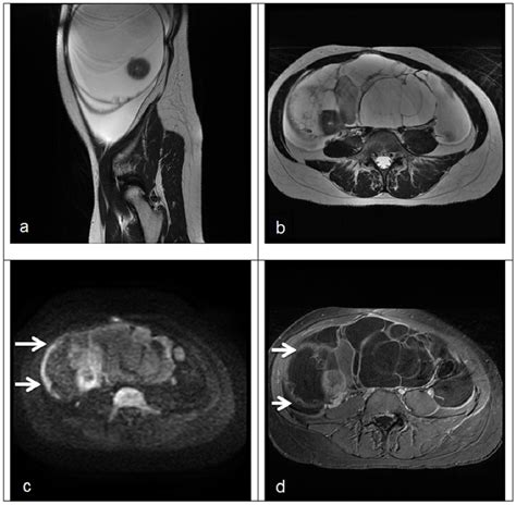 Figure 1 From Mri Features Of Primary And Metastatic Mucinous Ovarian