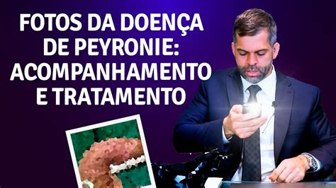 Fotos Da Doença De Peyronie Acompanhamento E Tratamento Dr Marco