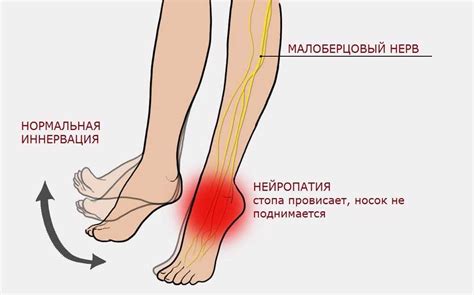 Нейропатия малоберцового нерва. Причина, симптомы и лечение неврита ...