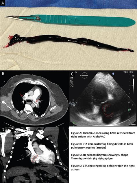 Successful Use Of Alpha Vac System For Thrombectomy Of Right Atrial