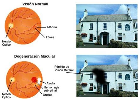 Clínica de Ojos Oftalmic Láser DEGENERACIÓN MACULAR Macular