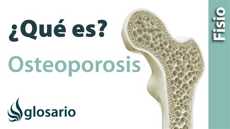 OSTEOPOROSIS Qué es YouTube