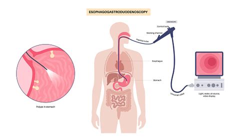 Gastroscopy Endoscopy Procedure Stock Illustration - Download Image Now ...